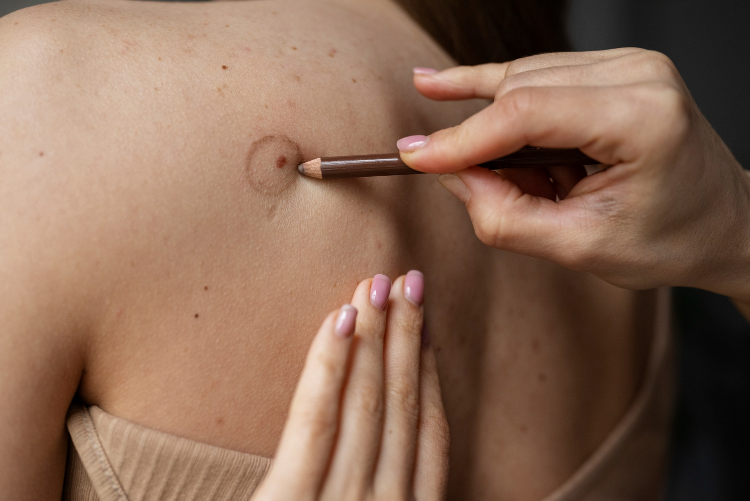 Chirurgie laser piele Timișoara – îndepărtare alunițe Dermasan