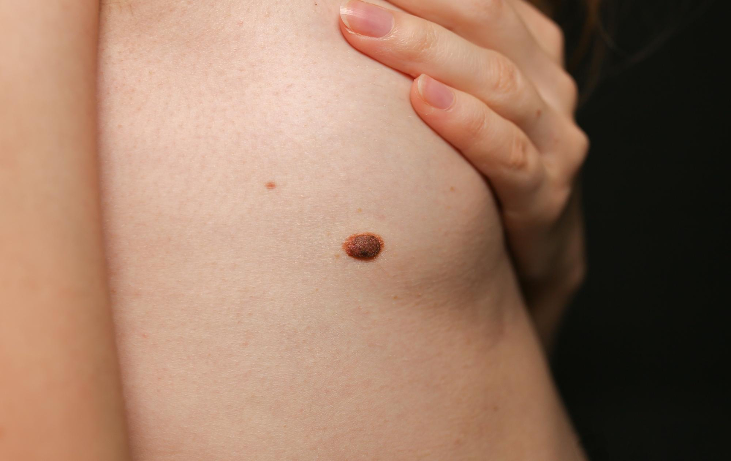 Dermatolog explicând rezultatele dermatoscopiei pacientului